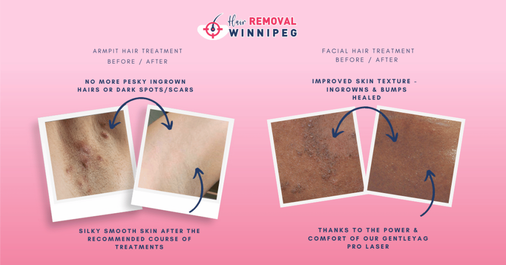 hair removal winnipeg before and after laser hair removal ingrown hair permanent removal