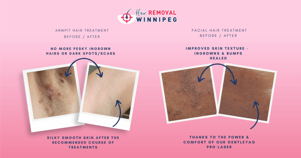 How Laser Hair Removal Helps Ingrown Hairs - Hair Removal Winnipeg