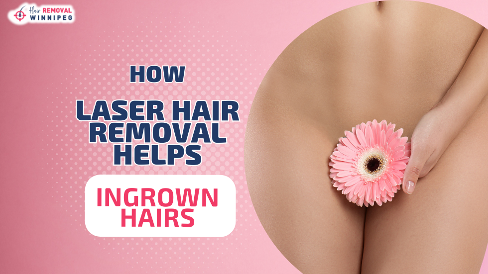 How Laser Hair Removal Helps Ingrown Hairs