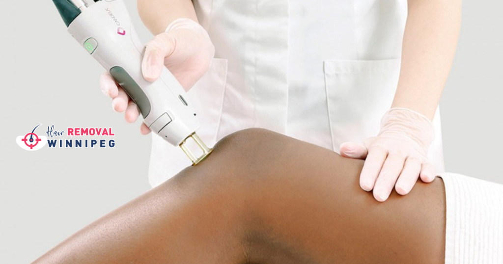a-dark-skin-client-getting-laser-hair-removal-with-the-candela-gentle-yag-pro-laser